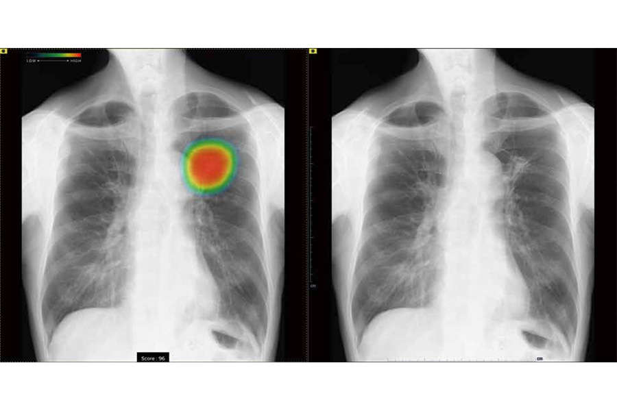 胸部X線画像 病変検出ソフトウェア Fujifilm社製 CXR-AID 胸部XP解析